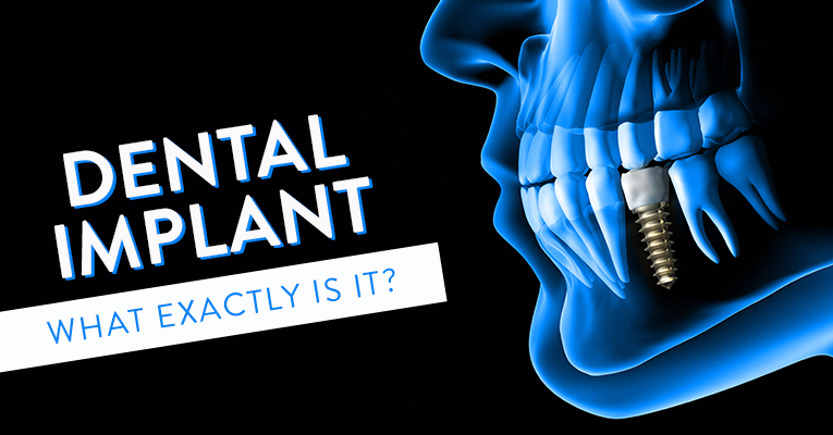 What Exactly is a Dental Implant